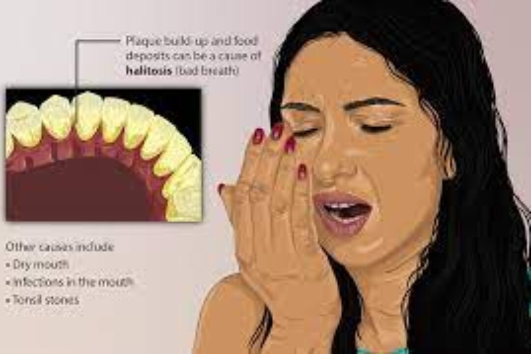Dealing with Bad Breath (Halitosis)