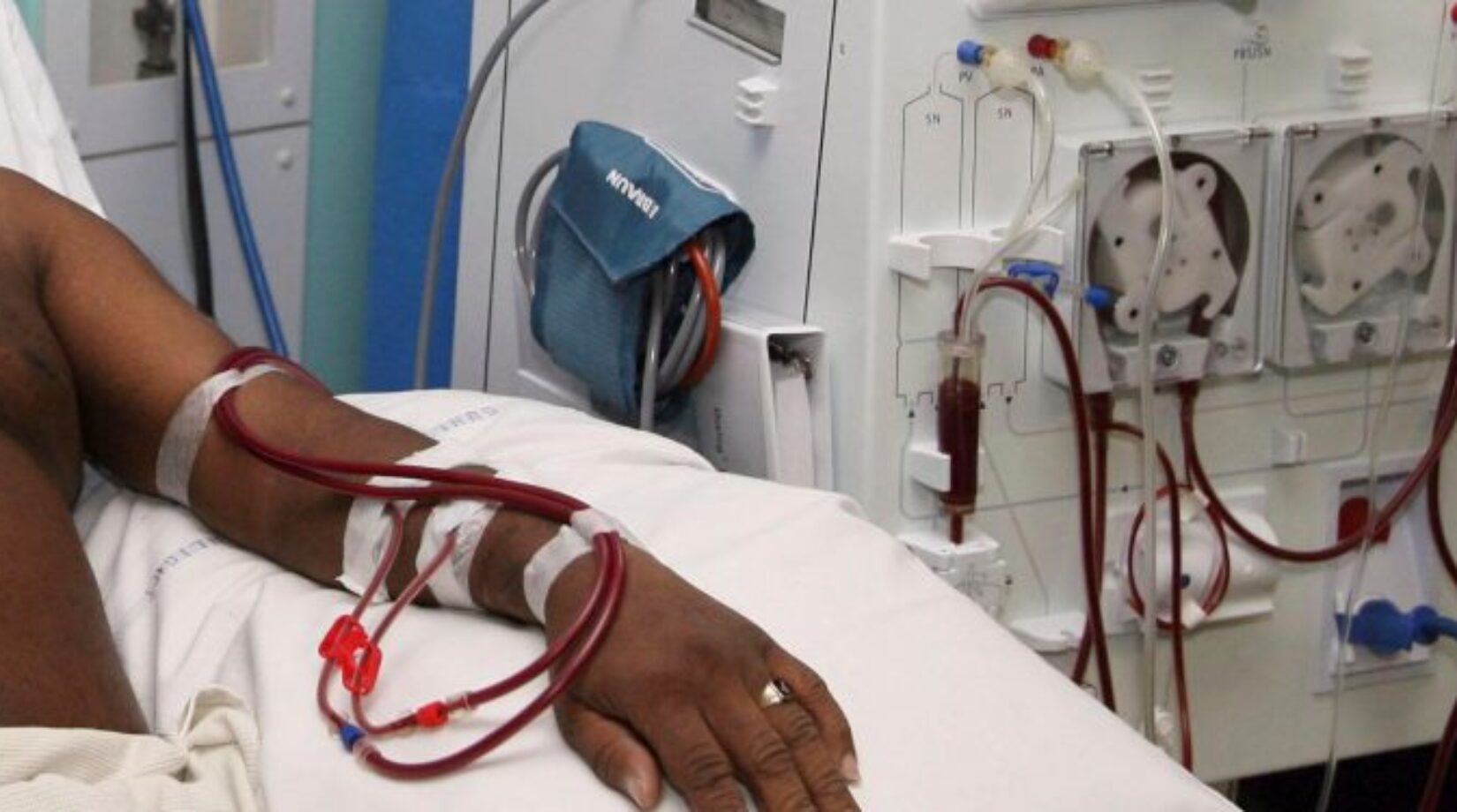 Dr.Bawumia announces free kidney dialysis for all NHIS patients from Dec 1