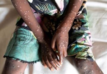 Ghana Health Service confirms 10 new Mpox cases, total rises to 19